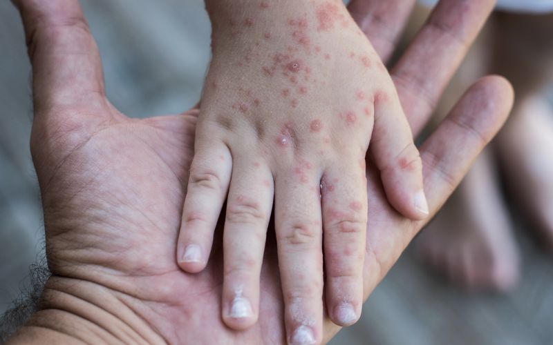 Rubella là bệnh gì?