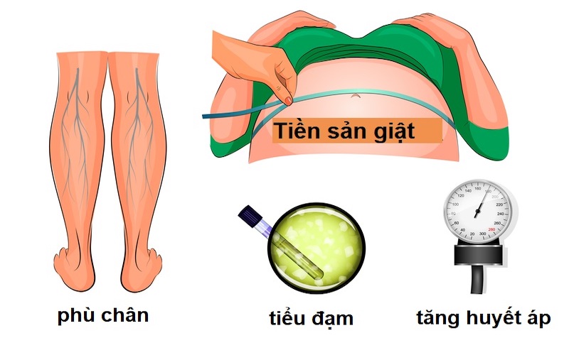 Tiền sản giật là gì?