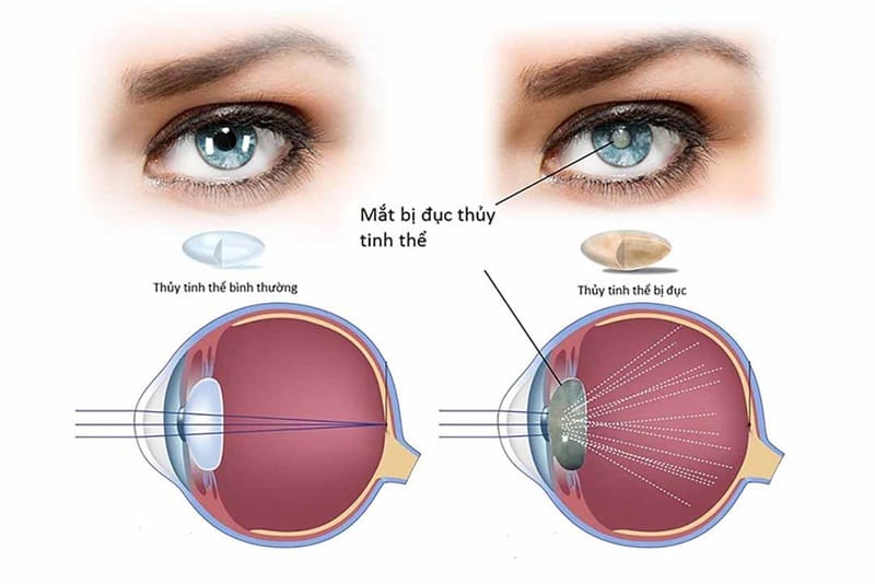 Mắt bị đục thuỷ tinh thể